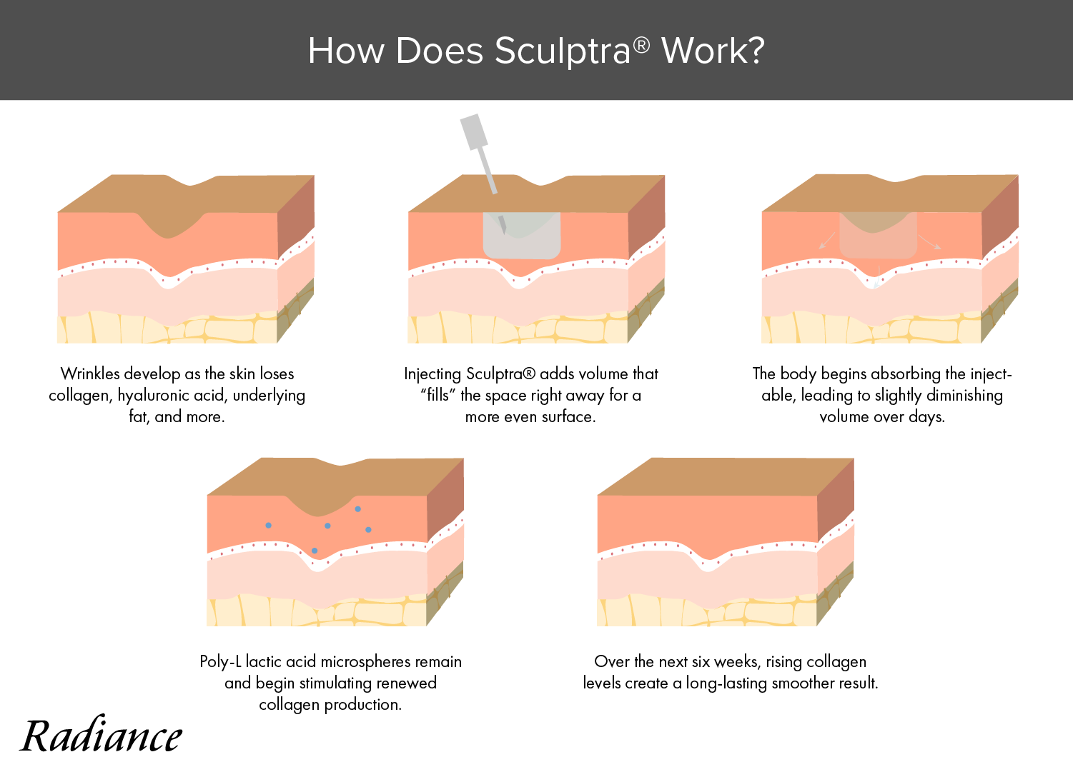 Learn what happens after injection with Sculptra at Madison, WI's Radiance Skin Therapy.