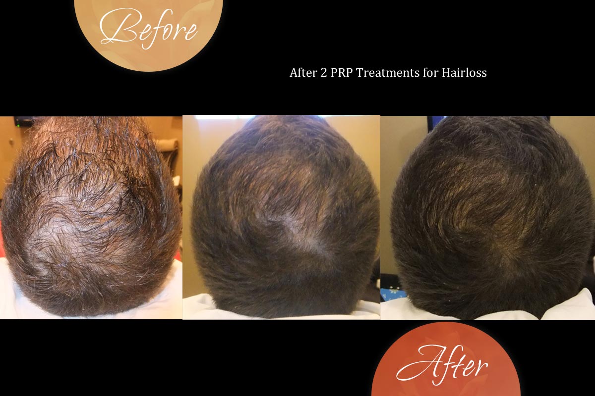 Hair Restoration | Madison | Radiance Skin Therapy