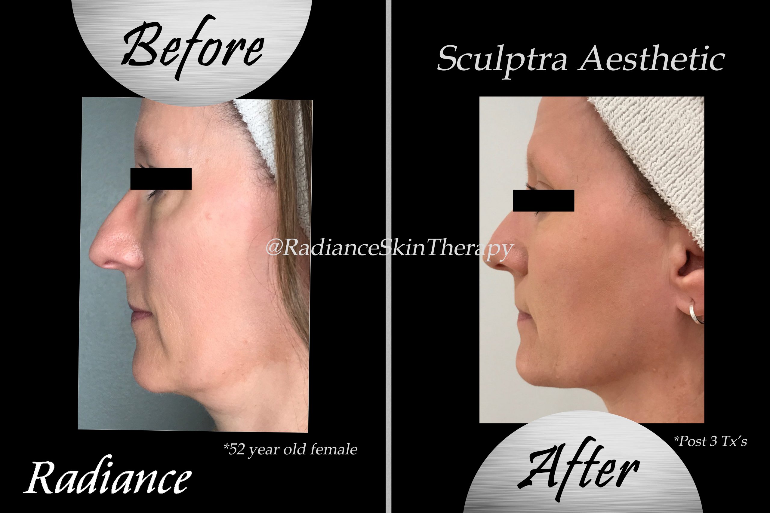 RST Sculptra Before and After Photos
